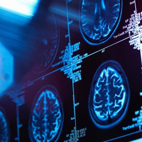 Image of MRI scans