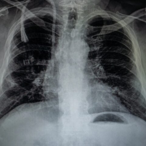X-ray of lungs.