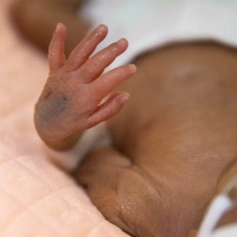 Photo of baby in hospital, zooming in on its bruised hand and torso.